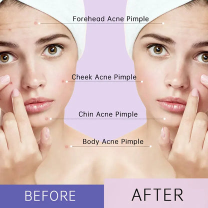 AUQUEST Invisible Zit Patch - Buy 1 Get 2 for Clear, Confident Skin